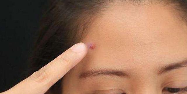 我要与你决“痘”，不再当痘女郎