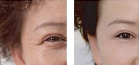 脸上有皱纹很显老, 每天涂抹点这些去皱物品, 紧致肌肤淡化皱纹