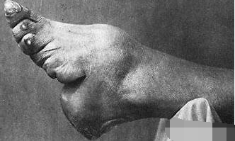 歷史解密: 誰是中國的第一個小腳女人