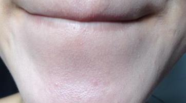 下巴鼻翼有白色“颗粒”，十个人中九人中招，你知道什么在作祟么