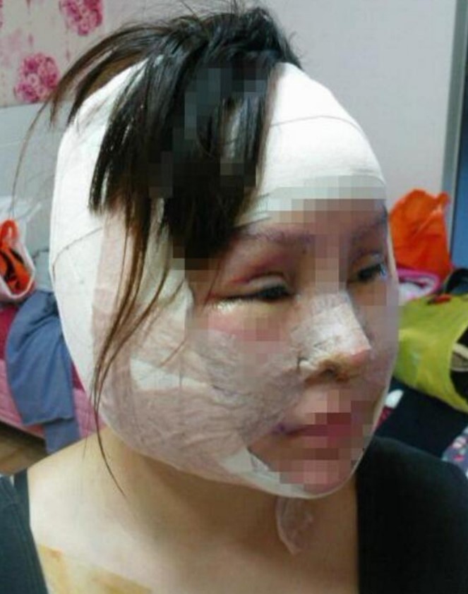 女子16岁开始整容, 花巨款整形200次, 整后样子让人看了心惊