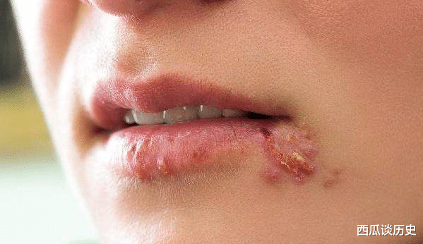 [排毒]嘴上长泡是在排毒？不，它可能暗示了这4种病