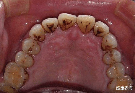 时尚好物官 “牙结石”别再用手抠，教你一招，脏东西自己往下掉了!