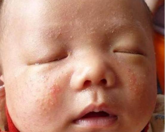 宝宝湿疹很难根治少数妈妈用3招就解决, 安全性高不说还少花钱