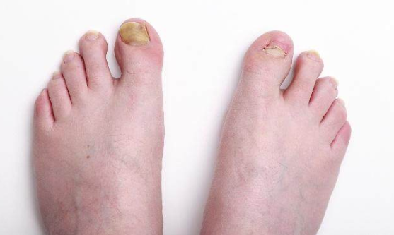 |男人脚上频繁有“3表现”，肾脏8成已“稀烂”，愿你1个不占