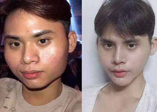 男子花4万多整容，吃1个月流食，外表满意了痛苦也值得