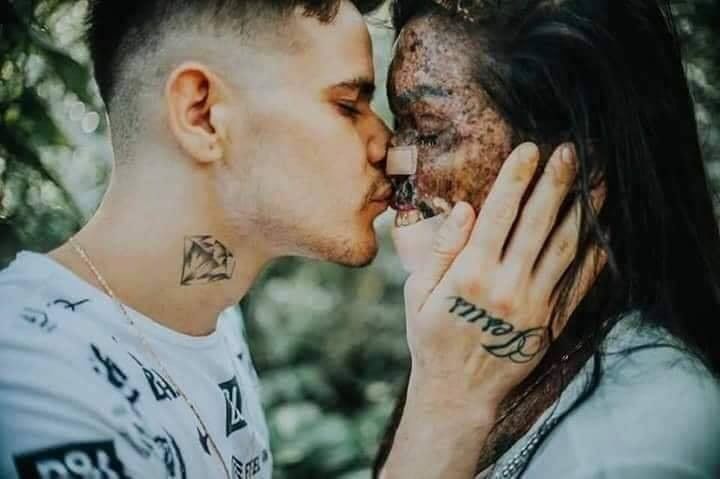 她严重烧伤，五官全无，混血男友不离不弃，捧脸颊轻吻