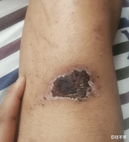 |“这种情况是等自然脱落，还是用手抠下来？”哈哈哈哈这tm谁忍得住