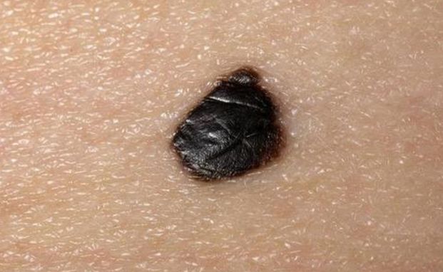 『肿瘤』体内有癌，皮肤先知？若出现4个标记，癌症已经“萌芽”