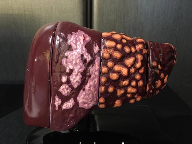 肝脏■肝病是拖出来的，提醒：身体出现一痒二痛三红，最好查下肝脏