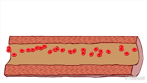 「脂肪酸」48岁男子，背痛了一天，骤然离世，医生措手不及，这病真的太凶险