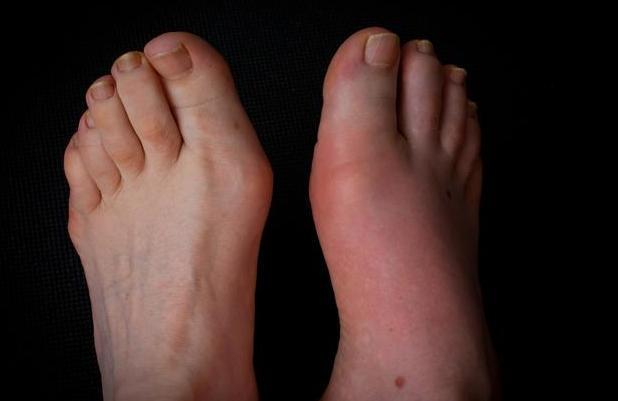 痛风|尿酸高的人不想痛风发作，4种食物尽早拉黑，别挑战身体极限！