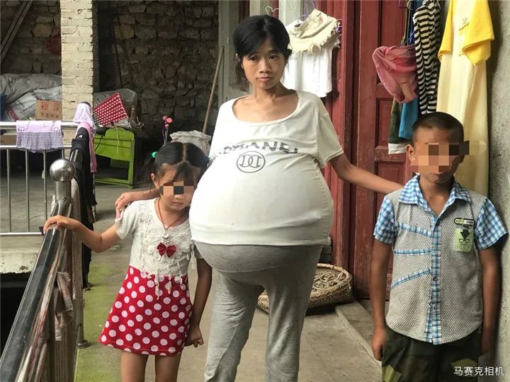 贵州|贵州女子肚子两年疯长成巨球，只能坐着睡觉……