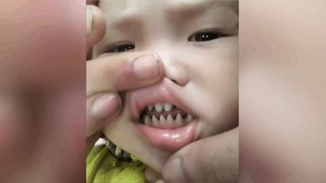 牙齿|5岁孩子长出一口“鲨鱼牙”,宝妈急忙送医,医生:只能怪你无知