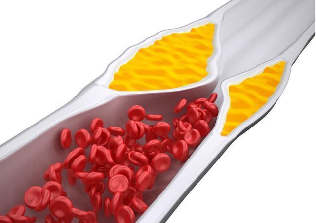 运动|血管不堵的人，早起会有3个表现，占1个也要恭喜，血管很畅通