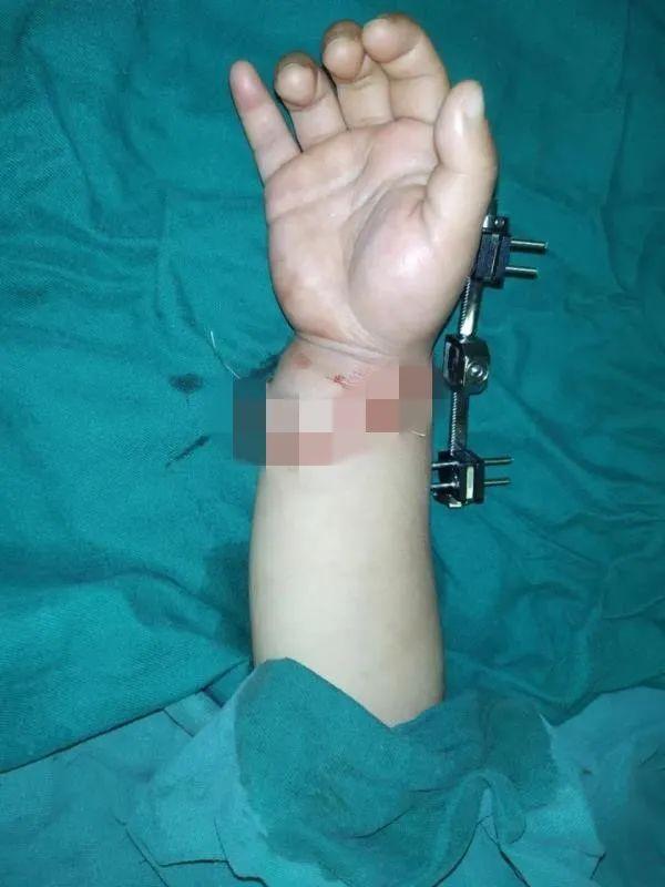 福州日报|福州2岁男童手臂被绞断！凶器很常见！