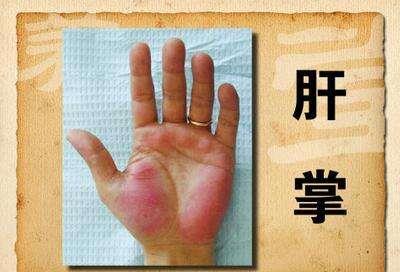 「肝脏」肝开始变硬，身体会出现5种异常，若一个不占，说明肝还不错