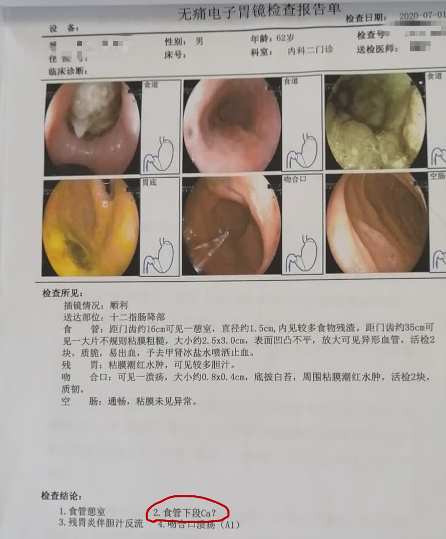 食管癌|62岁老汉咽喉不适以为是咽炎，却查出食道癌，两者如何区分？