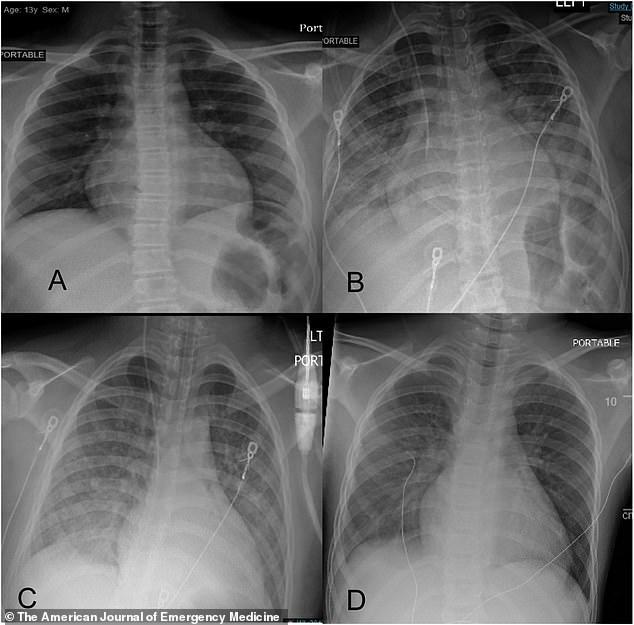儿科■为何幼儿染新冠会出现川崎病，美医生终于揭开谜团：细胞因子风暴