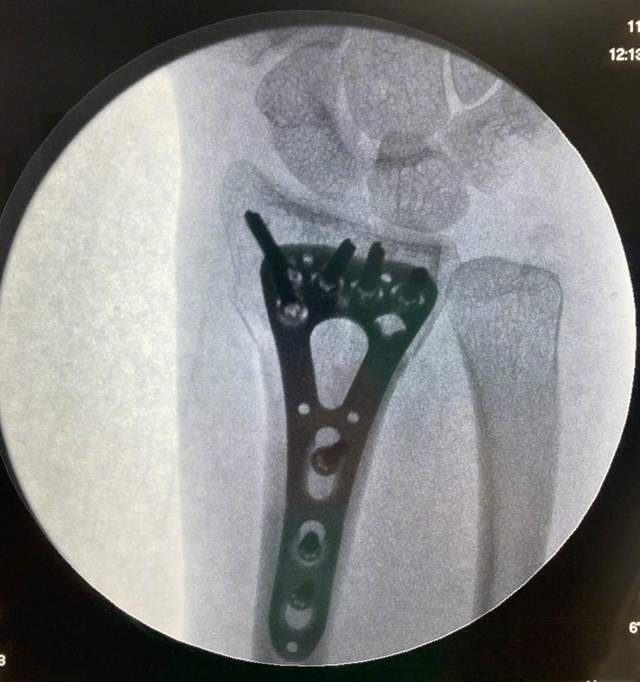 谢楠|吴京曝谢楠桡骨钢钉照!形状像耙子看着就疼,两人乐观互动显甜蜜