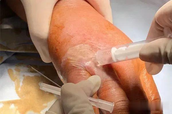 杭州日报|为了吃口螃蟹,杭州男子手烂了!每年这季节高发,医生:别再自作聪明...