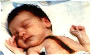 狒狒|移植动物器官：36年前女婴为活命，移植狒狒心脏，现在怎么样了？