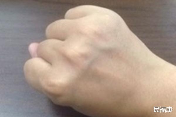 「」为什么有些人手上青筋多且凸出?青筋越多,说明身体越差?