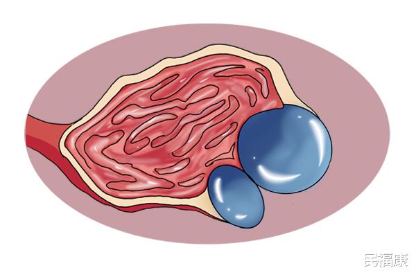 卵巢囊肿|医生直言：女性身体这3处若是亮起“红灯”，可能是长了卵巢囊肿
