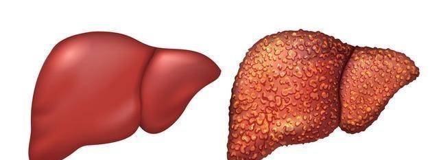 枸杞|肝病不是“悄无声息”，不管男女，眼睛若有4种表现，早查肝CT