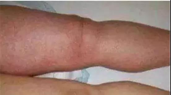 #癌细胞#体内有癌，“腿”先知，“腿部”若有这3异常，可能有癌细胞了！