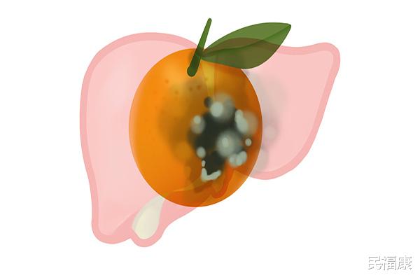 肝癌|肝癌不是突然就来，大小便早就给你暗示，只要发现，请尽快就医