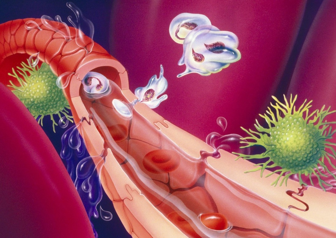 高血脂|高血脂7种食物不能多吃，降血脂记住“1喝、2戒、3运动”