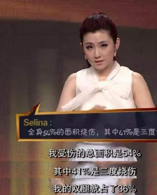 #俞灏明#Selina当年烧伤，为什么要恨救她的俞灏明？真相大白