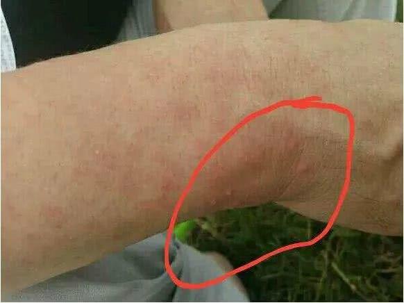 「」艾滋病慢慢接近时，皮肤上往往会有4种“异常”，希望你一个没中