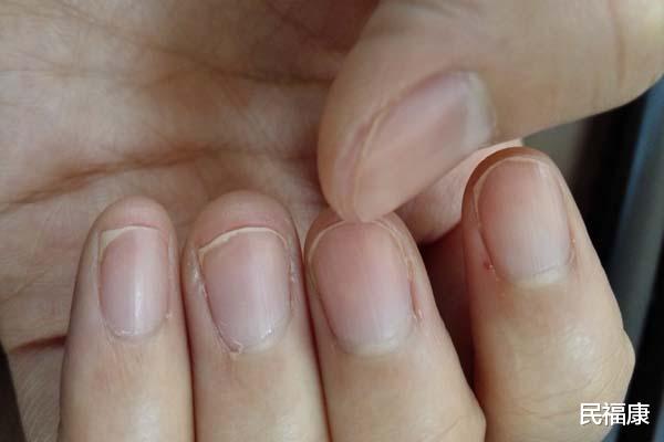 疾病|指甲上有竖纹，暗示体内有大病？指甲上的秘密，是时候揭开了