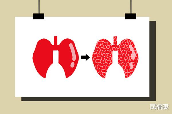睡眠|肺癌突袭时，睡眠首先知晓！睡觉时总有异常迹象，赶紧给肺做检查