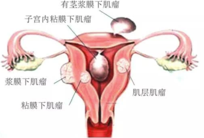 #高血脂#得子宫肌瘤后会有哪些表现?