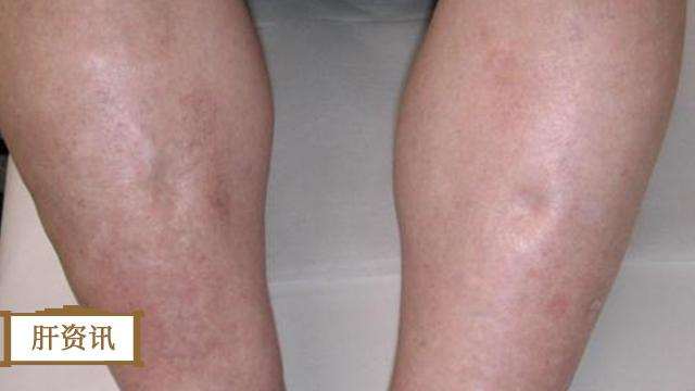 乙肝:早期肝硬化可逆转, 身上长出这些, 抓住治疗黄金期, 肝硬化能好一半
