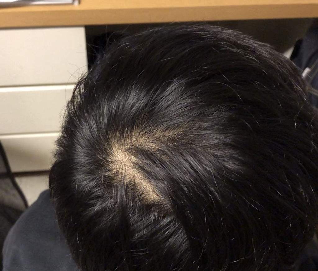 雄激素|男人身体若出现这4个迹象，或是在提醒：雄性激素快要“干涸”了