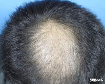 脱发|现在头发是不是越来越少了,教你一些养护的方法
