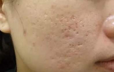 痘痘▲为什么痘印老是消不掉？