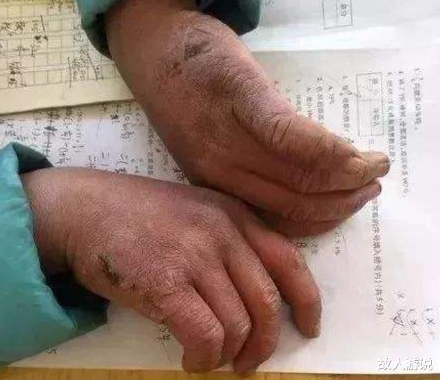 冻伤|2年前,那个满头冰花、脸蛋冻伤也要上学的男孩,现在怎样了?