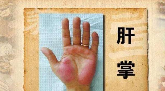 [肝脏]肝变“硬”之前，身体并非毫无征兆，若有4种表现，要多留个心眼