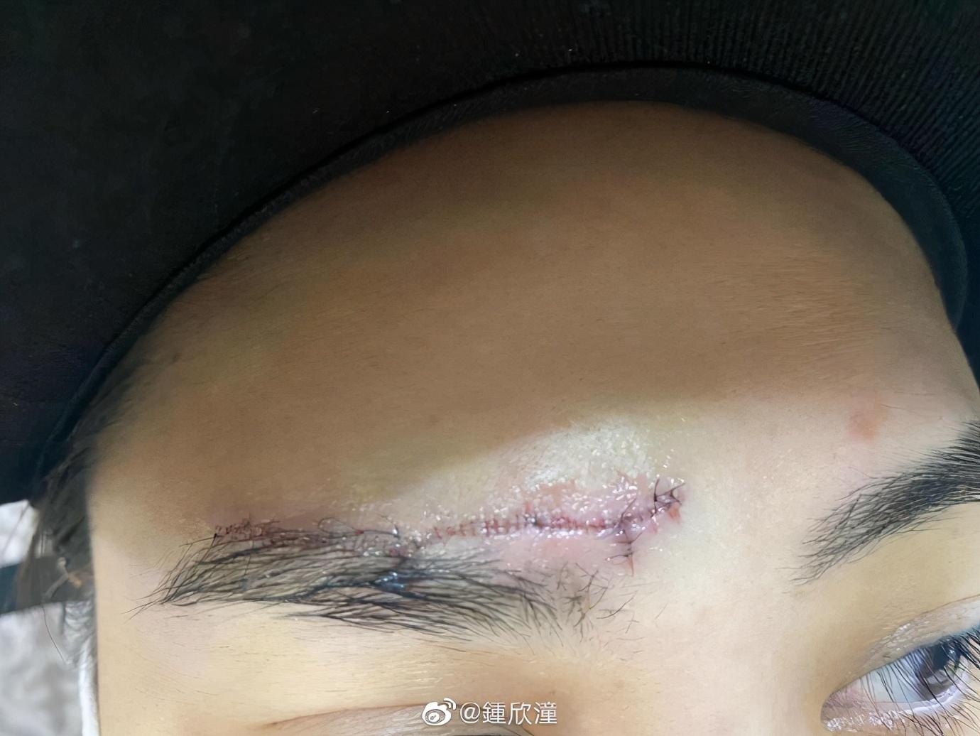 阿娇|阿娇发文报平安，公开额头伤口缝针照，近照憔悴消瘦让人心疼