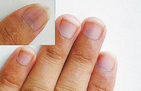 「新陈代谢」指甲上月牙越少,就代表身体越差?是时候告诉你真相了!