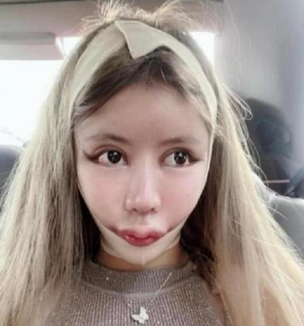 「芭比娃娃」当初砸100万，将自己整成“芭比娃娃”的13岁女孩，现在长相成这样