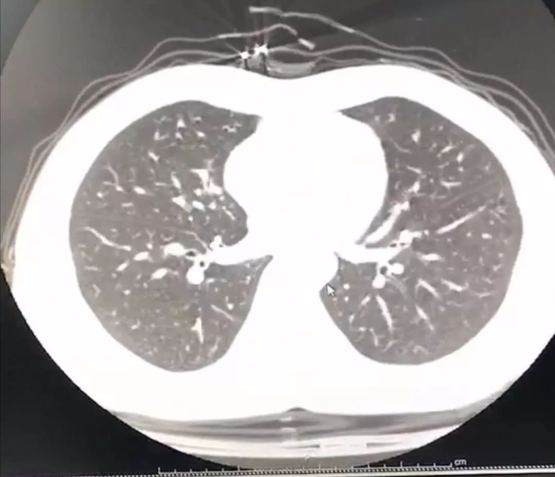 疑似感染新冠病毒，自我隔离四天好转，同济医院周医生是怎么做到的？