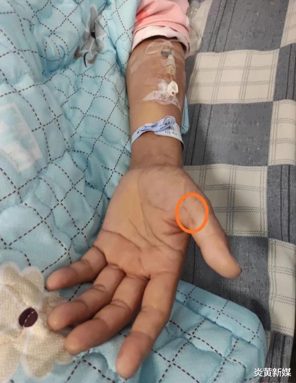 炎黄新媒|吓人！一女子在处理猪肉时被骨头刺破手，患罕见疾病！全国仅见200多例！