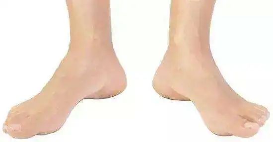 孕妇|走路外八需要怎样纠正？