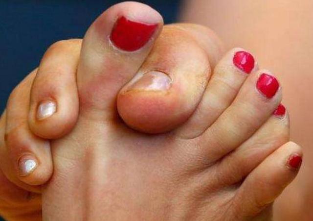 肝脏|肾不好的人，脚上会有3个“症状”，若你没有，肾病或许悄悄好转